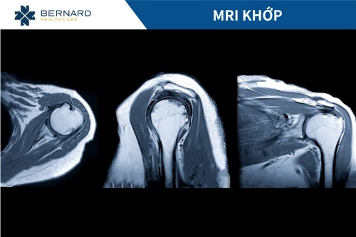Chụp MRI khớp